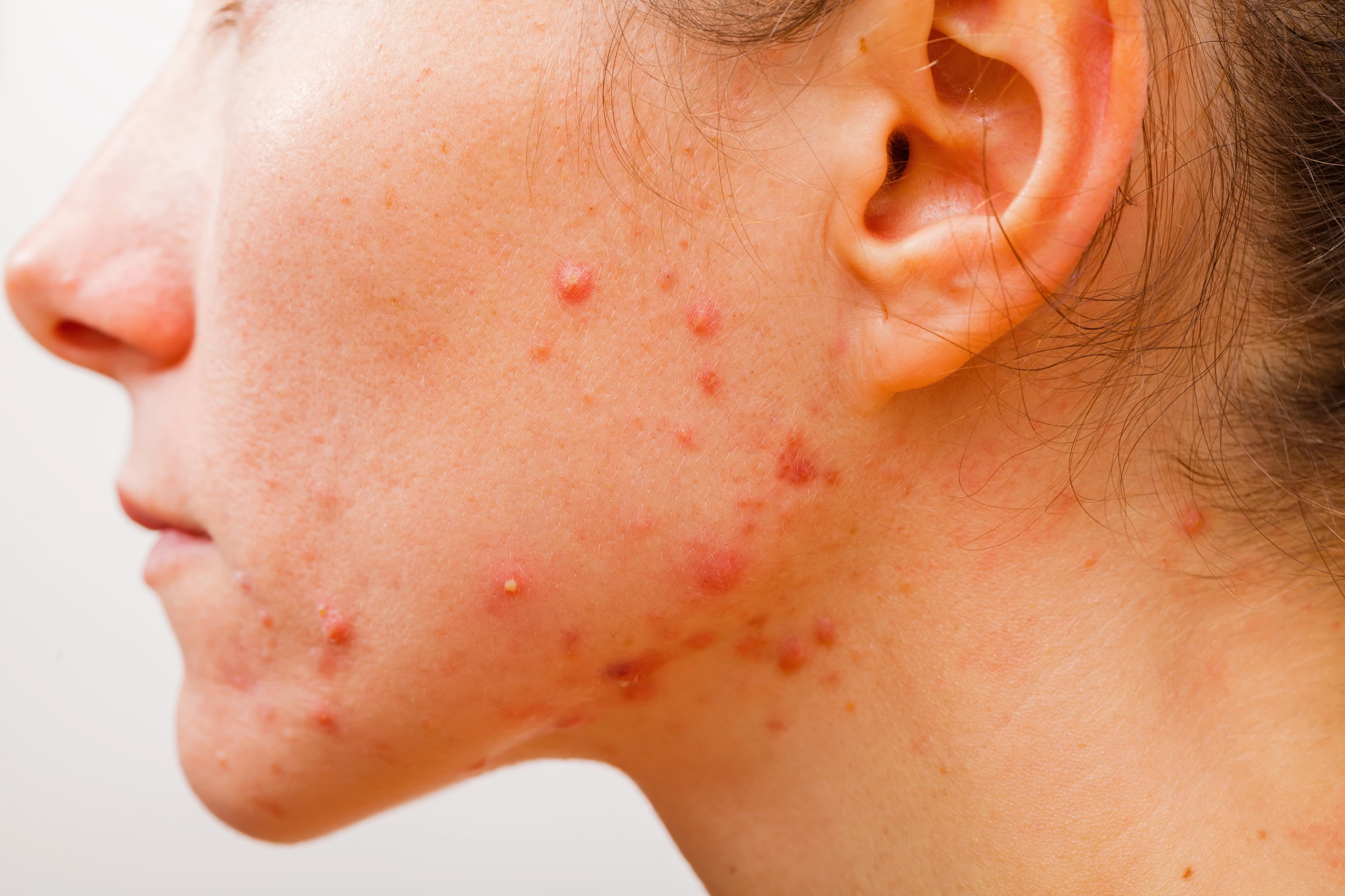 Acne, pimples or skin issues